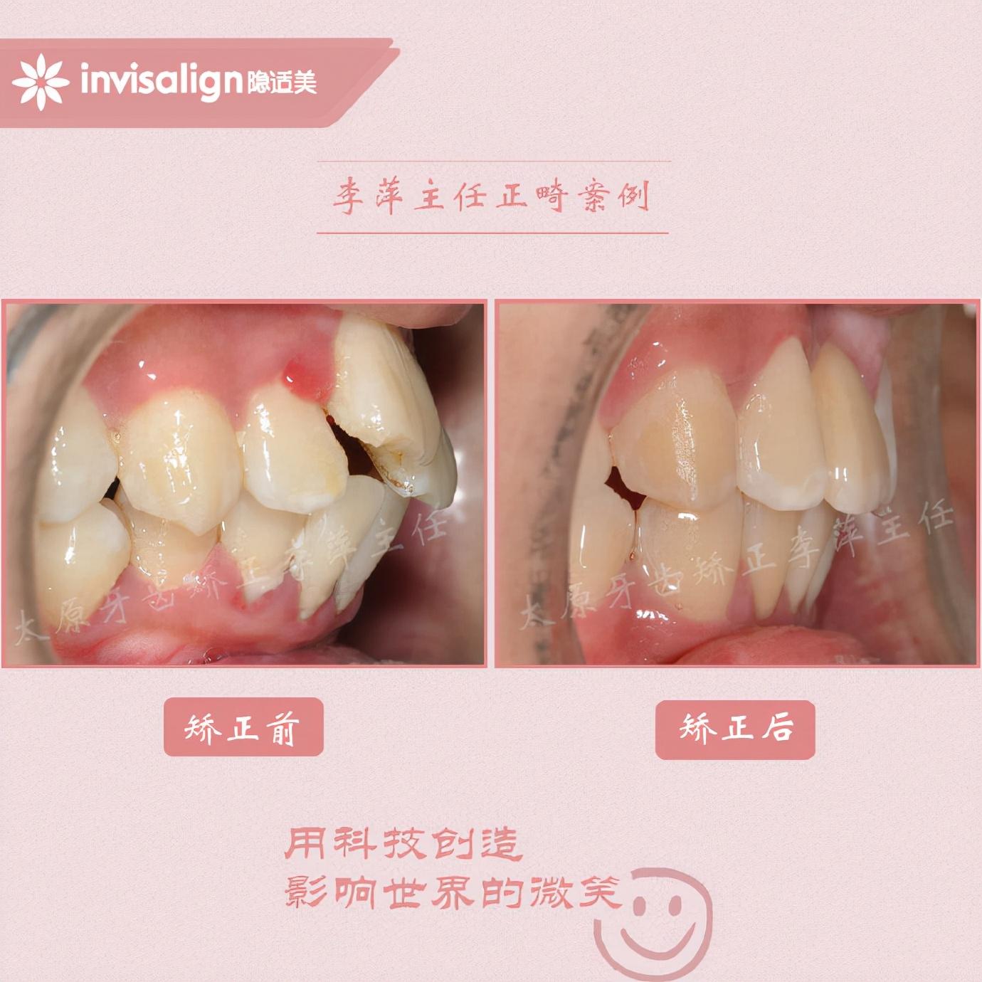 最新牙齿矫正技术，重塑灿烂笑容